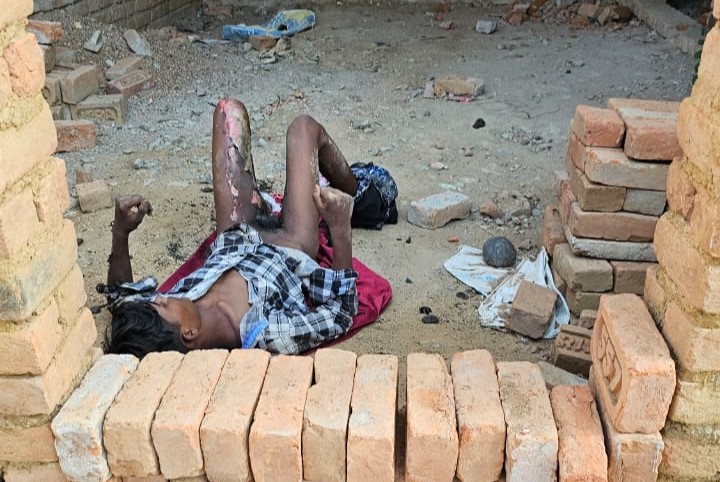 While stealing, he got electrocuted and his leg got burnt