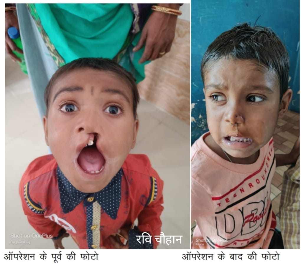 Treatment of child's lip surgery in village Satumri